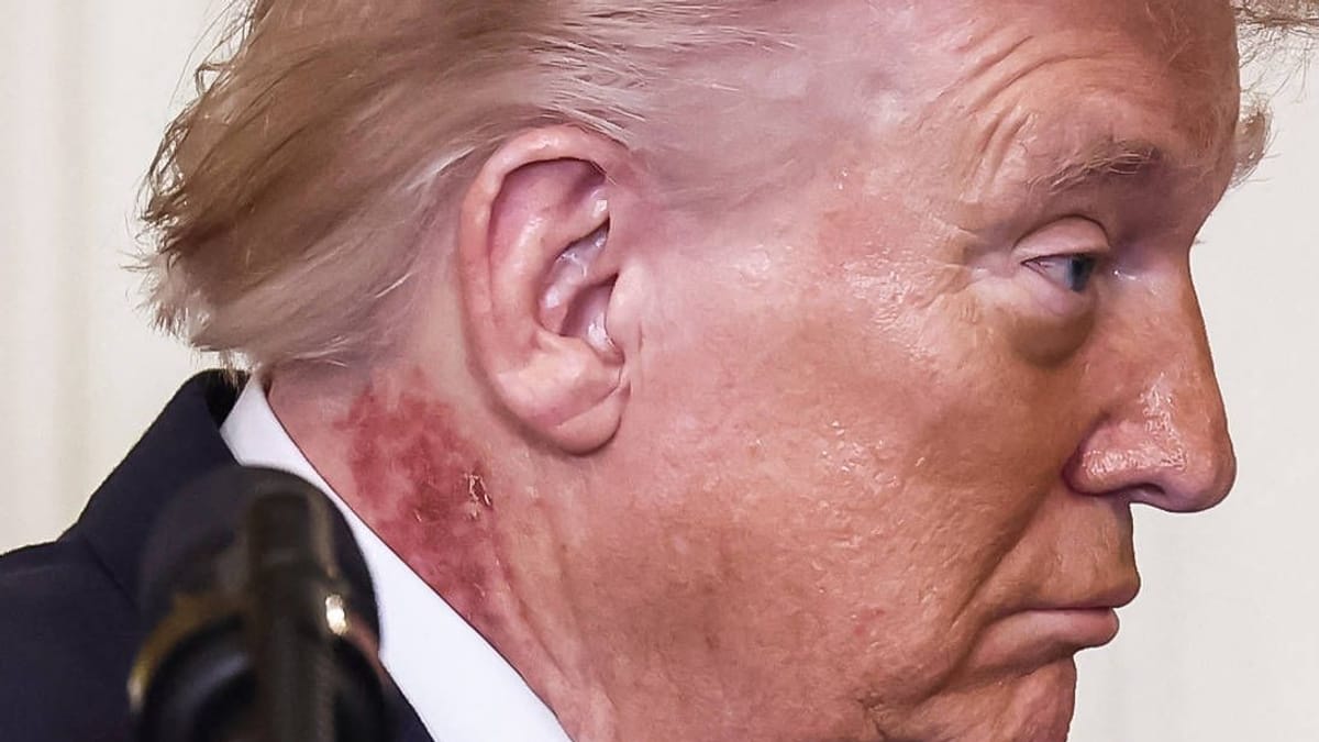 Trump's Neck Rash Explained: Doctor Reveals Preventive Skin Treatment